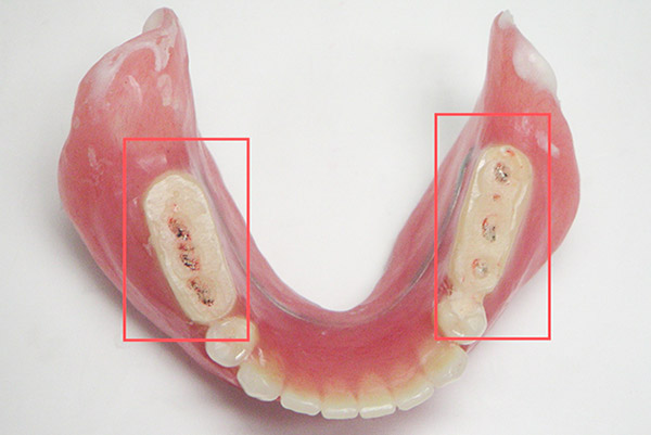 診断用義歯